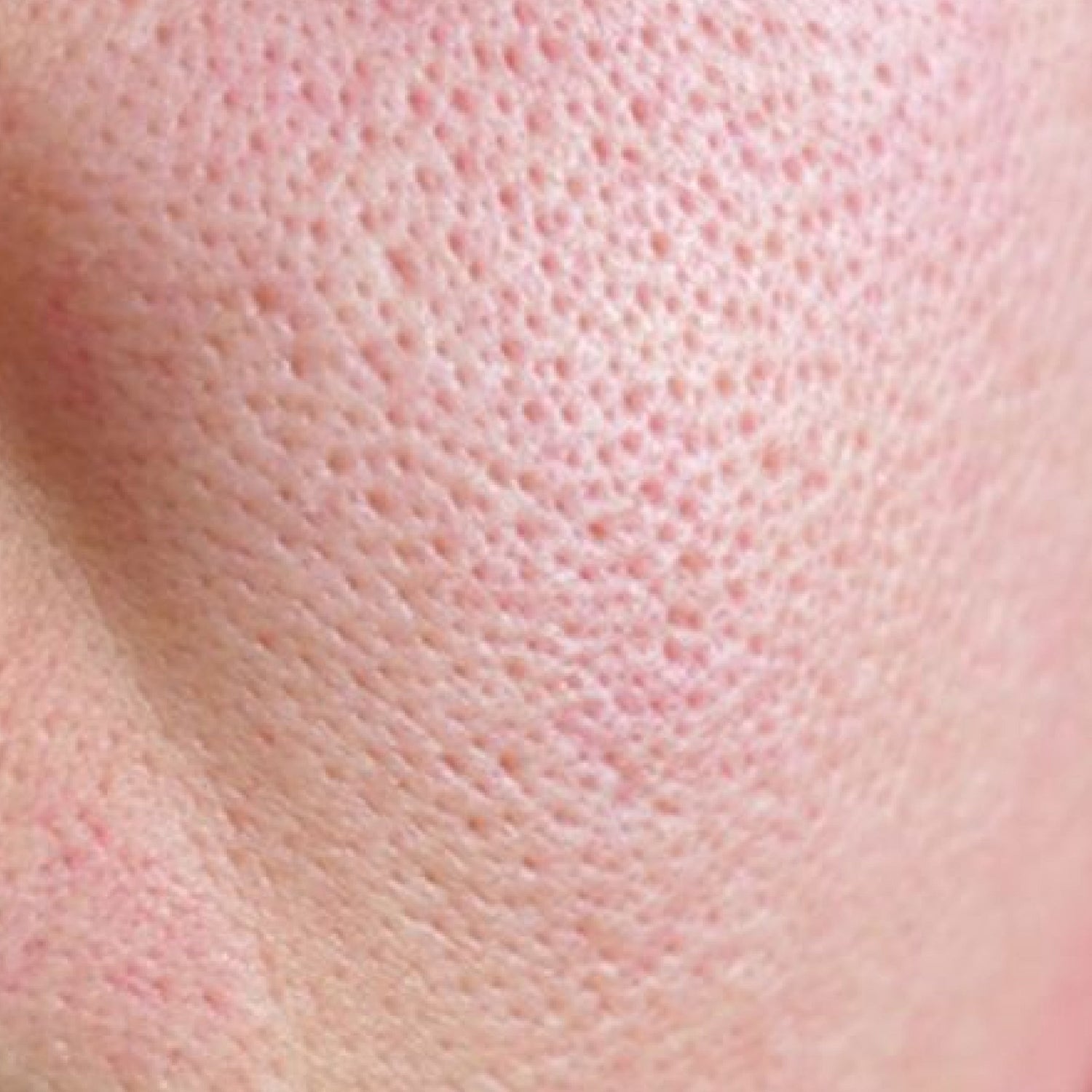 Imperfections & Éruptions - Avure Skincare